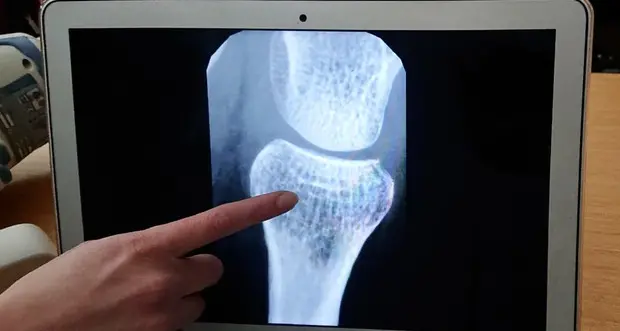 Giornata dell’osteoporosi, domani visite di prevenzione e sensibilizzazione per tutti