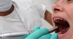 Carie fantasma, dentista condannato