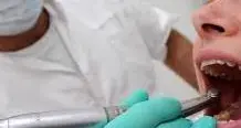 Denti storti e «nerastri», fa causa all’odontoiatra