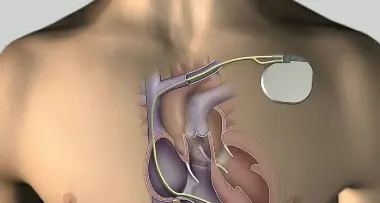 L'apparecchio che riavvia il cuore