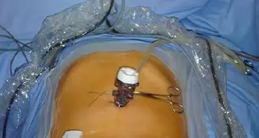Medicina: utero asportato dall'ombelico, a Trento il primo intervento in Italia