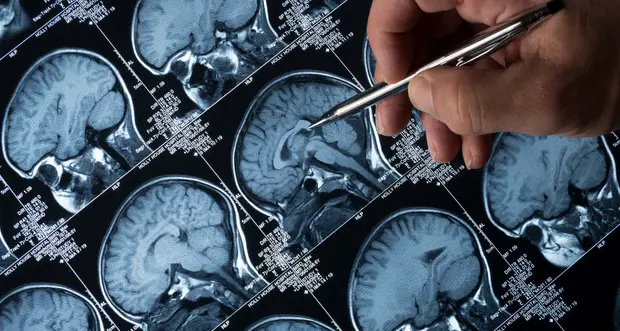 Tumori al cervello, diagnosi veloci grazie all’intelligenza artificiale