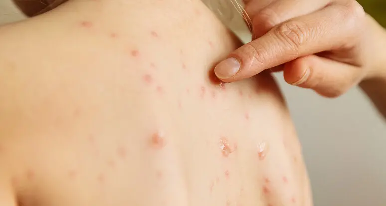 Caso di morbillo in un bimbo non vaccinato in Valle di Fassa, l’Azienda sanitaria allerta i pediatri